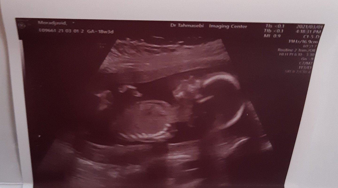 هفته-۲۳-بارداری مهرسام عرشیان