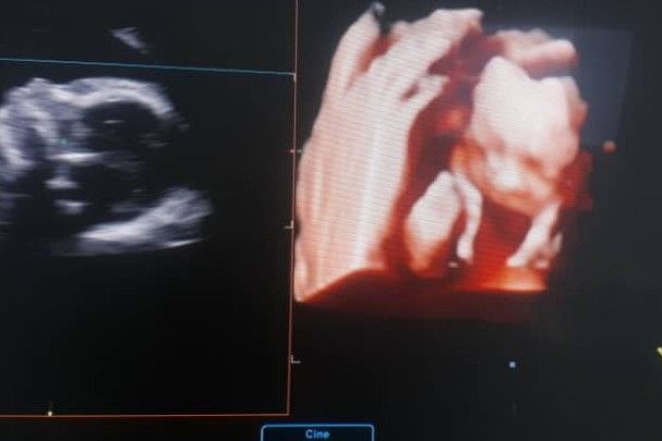 بارداری میکائیل نگهداری