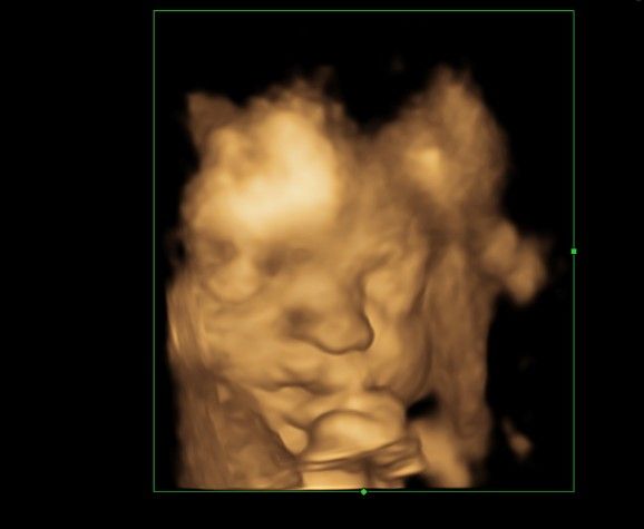 بارداری آرشام